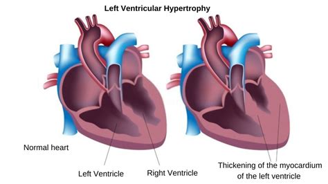 left ventricular hypertrophy weight loss